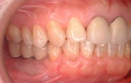 インプラント　下の奥歯